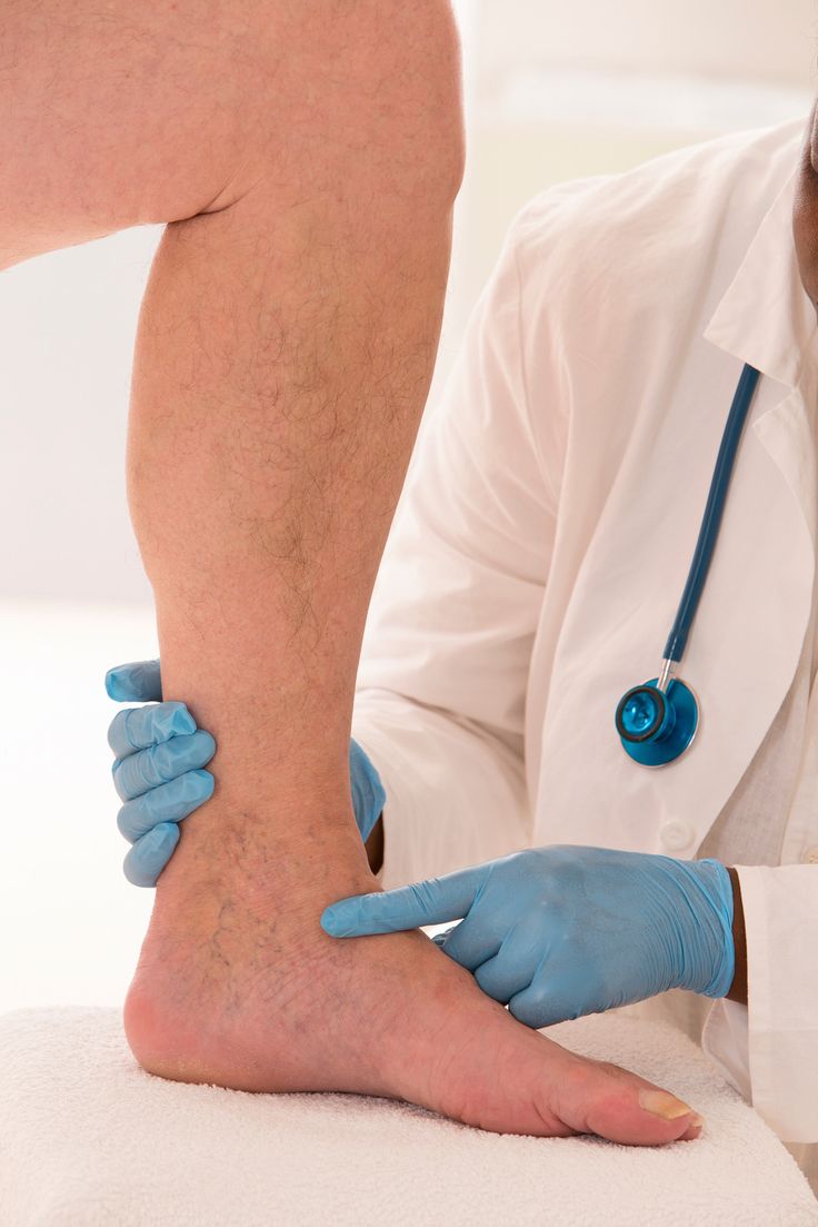 Varicose Vein Care