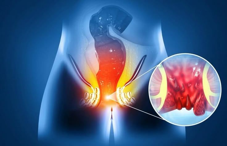 Hemorrhoid Solutions